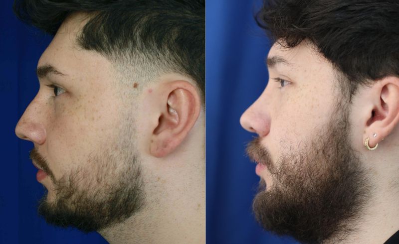 Rinoplastia_drjaimeramirez (1)