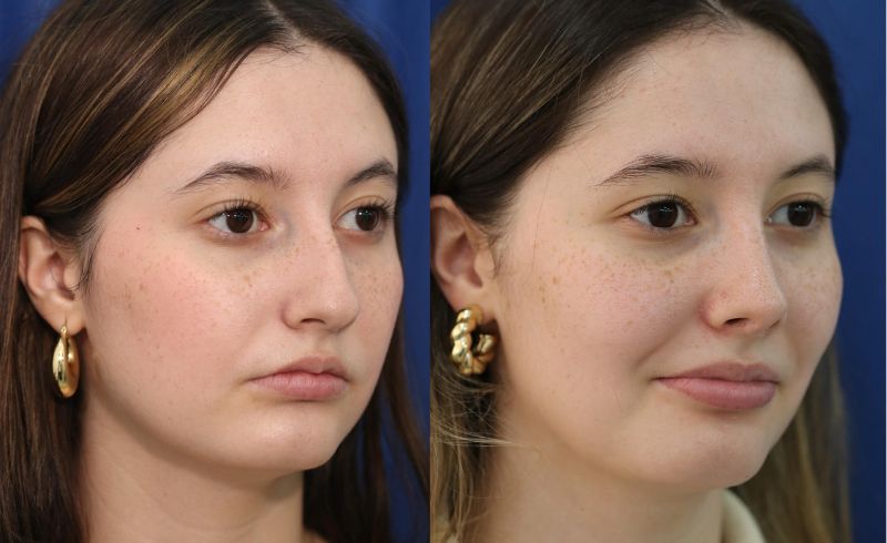 Rinoplastia_drjaimeramirez (2)