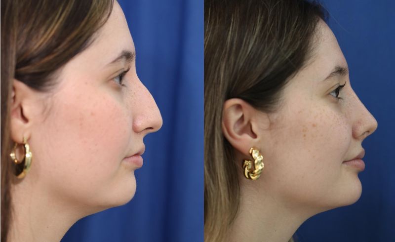 Rinoplastia_drjaimeramirez (3)