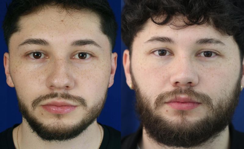 Rinoplastia_drjaimeramirez