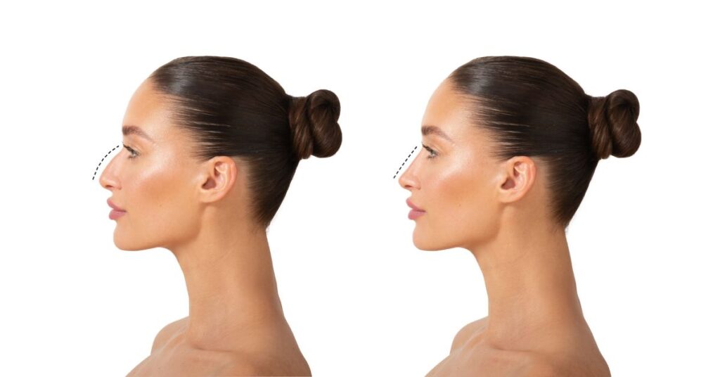 Where Can I Find Before-and-After Galleries of Rhinoplasty Patients in Colombia