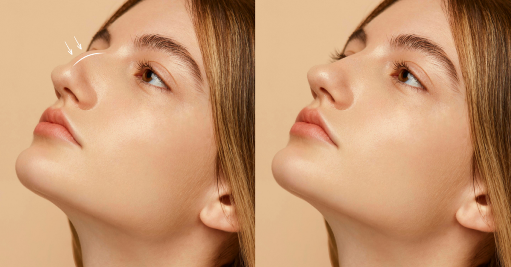 Rinoplastia en Bogotá: Precio y Recuperación 
