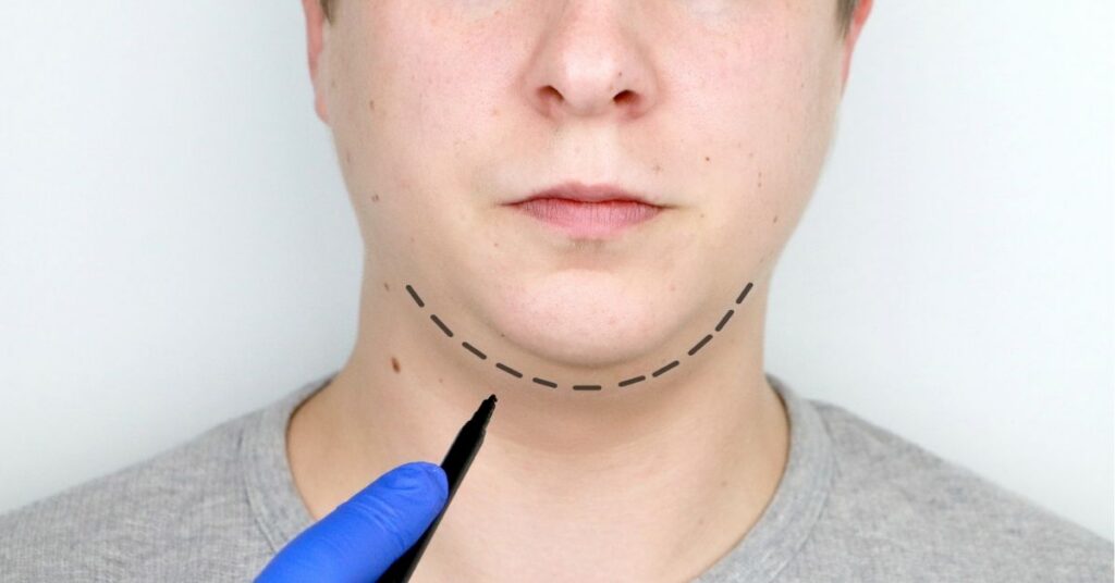 Mentoplastia: cómo la cirugía de mentón puede transformar el equilibrio de tu perfil